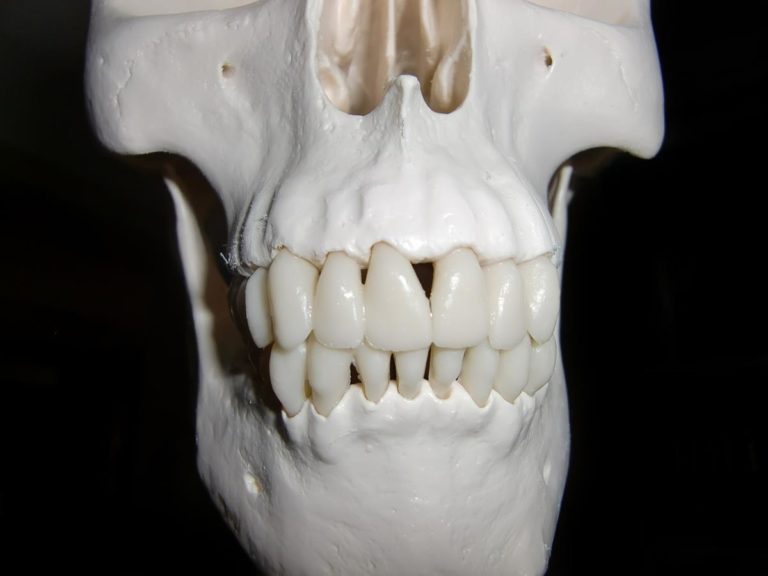 Ortodontyczny aparat stały – co warto o nim wiedzieć?